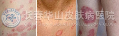 玫瑰糠疹的治疗