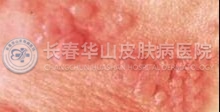 带状疱疹