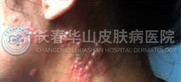多见不典型带状疱疹